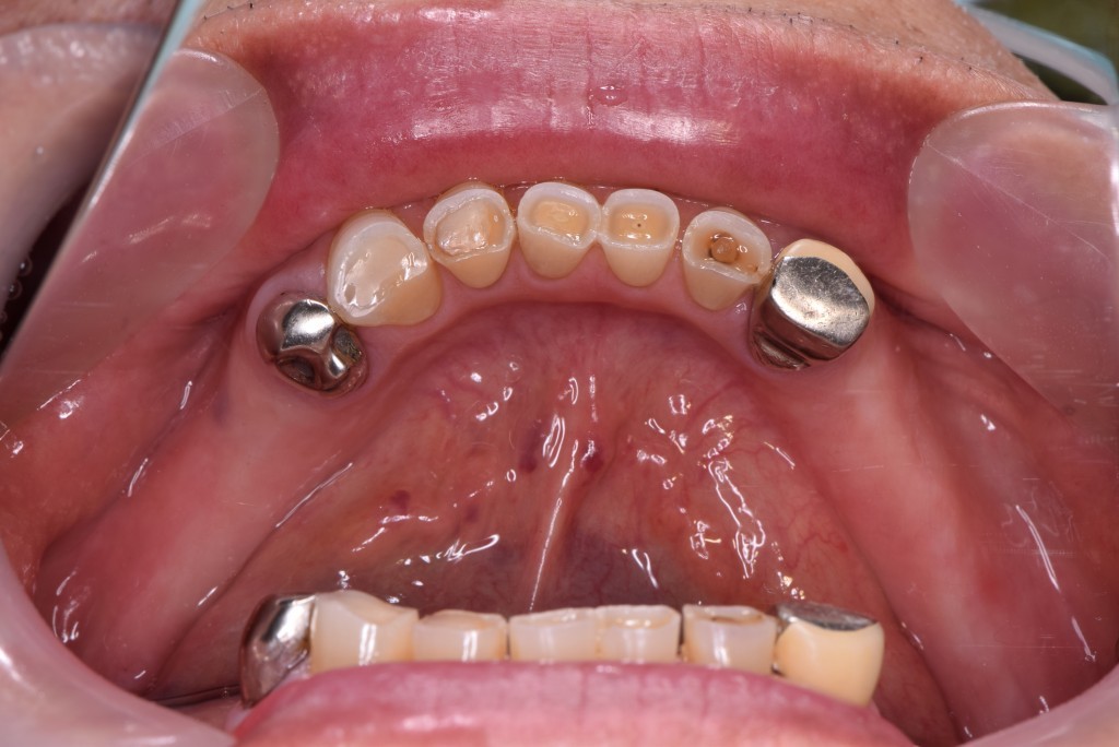 入れ歯とインプラントを併用