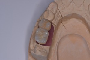 骨のない奥歯にサイナスリフトでインプラントを埋入