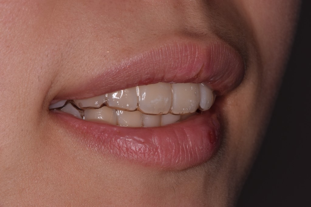 マウスピース矯正とは