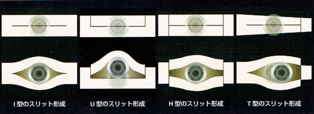 骨の幅が狭い場所のインプラント について