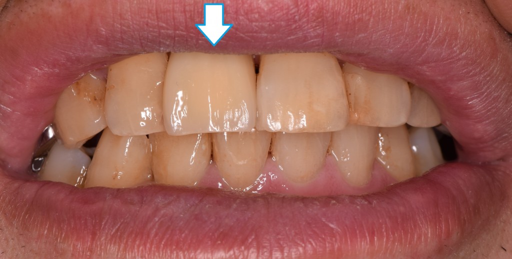 もっと早く歯のインプラントに出会っていれば