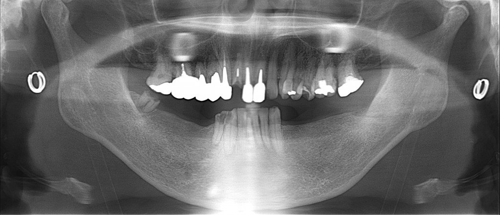 奥歯の噛み合わせが基本