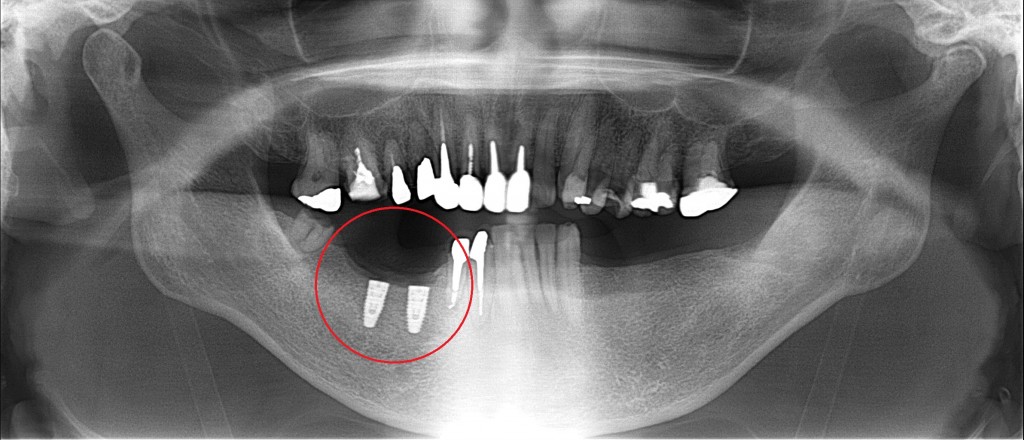 奥歯の噛み合わせが基本