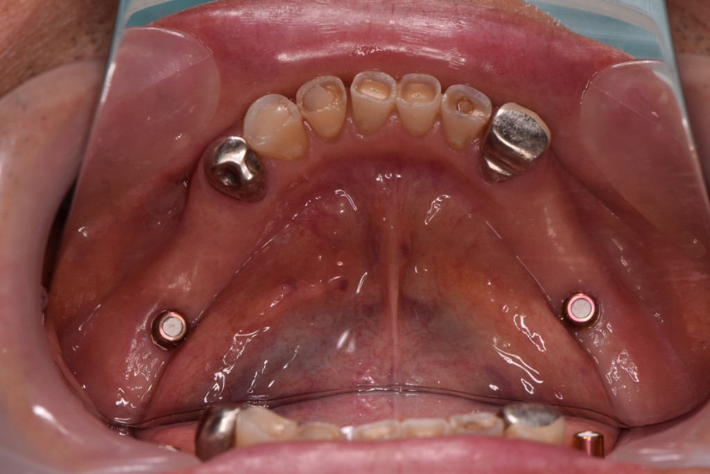 しっかり咬めて他の歯に影響の少ない治療法