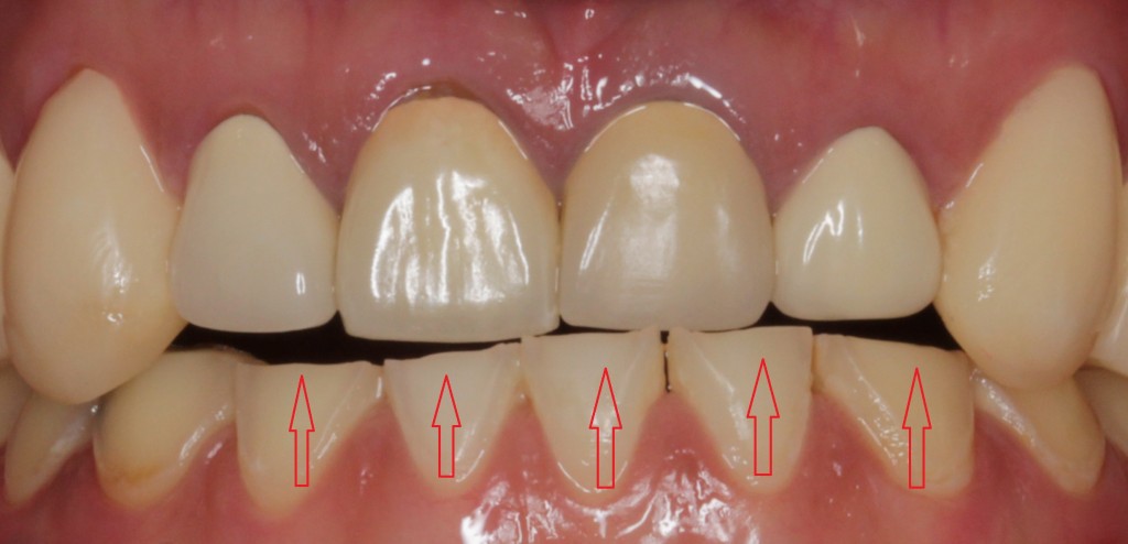歯がしみる症状と歯ぎしりの関係
