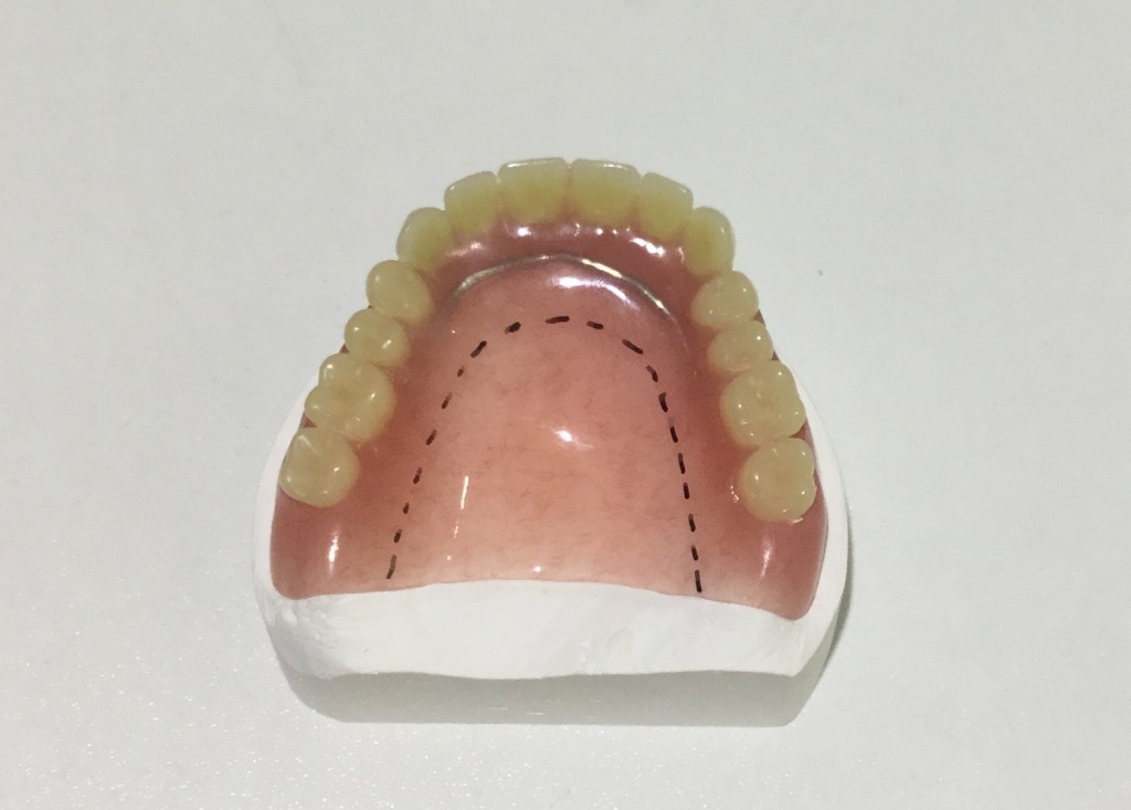 総入れ歯の欠点