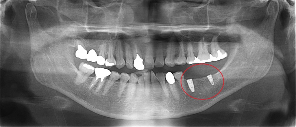 他の歯を失うリスクのない治療法インプラント