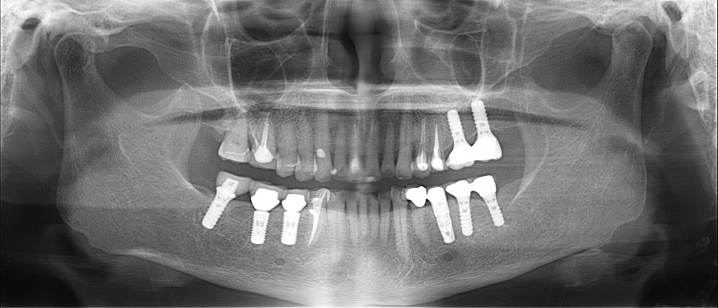 インプラントと入れ歯の比較