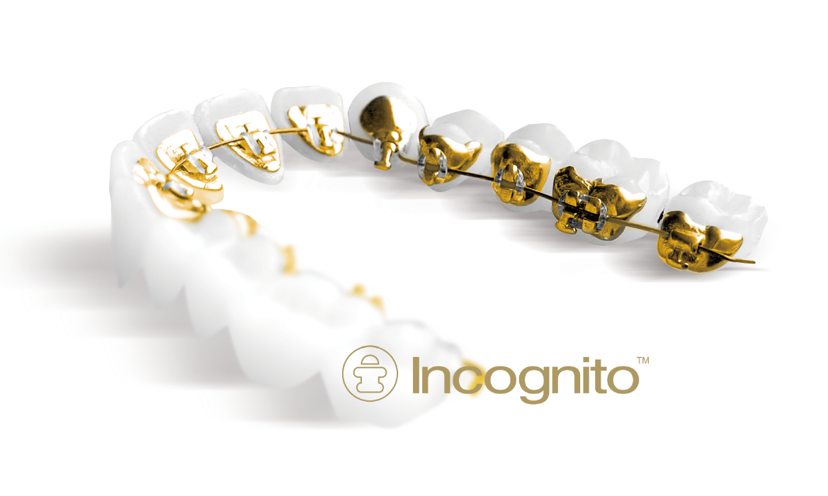 裏側矯正インコグニト