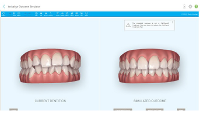 口腔内スキャナ