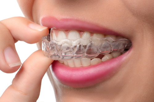 インビザライン