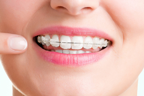 ラビアル表側矯正