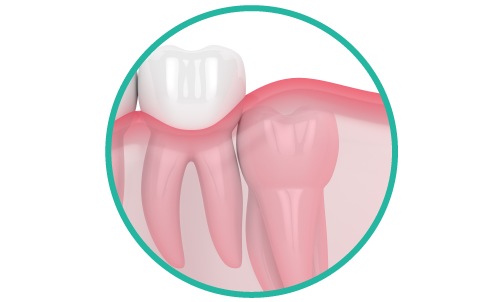 歯茎に埋もれた親知らず