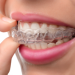 インビザライン